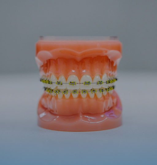 assets/images/treatment/Braces & Aligner.jpg